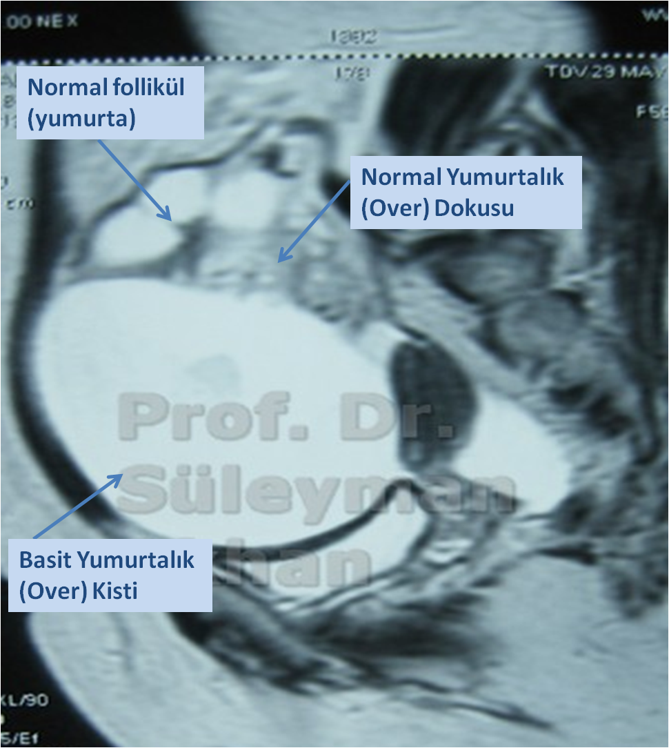 BAsit Over Kisti Prof. Dr. Süleyman Engin Akhan Prof. Dr. Süleyman Engin Akhan
