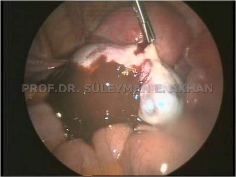 Genç Kızda Endometrioma Prof. Dr. Süleyman Engin Akhan Prof. Dr. Süleyman Engin Akhan