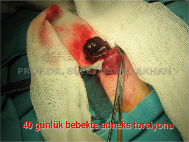 Over Torsiyonu, Yumurtalığın Dönmesi 1 Prof. Dr. Süleyman Engin Akhan Prof. Dr. Süleyman Engin Akhan